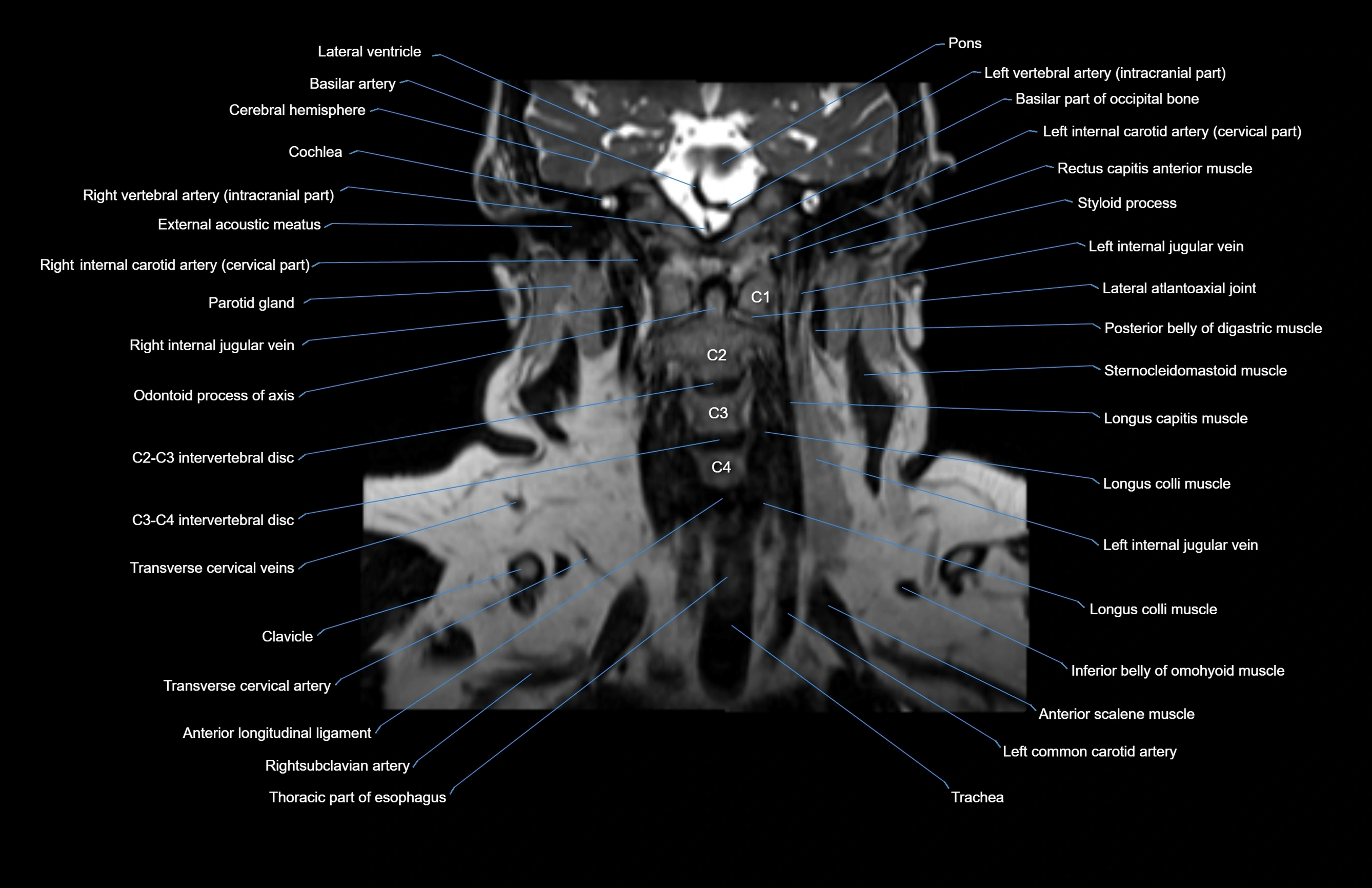 Neck coronal cross sectional MRI anatomy 3T MRI  image-img-00001-00033.webp